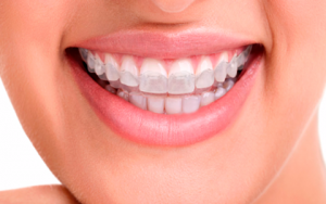 blanqueamiento-dental-por-cubetas-lina-fernandez-odontologia-medellin