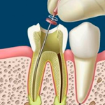 Endodoncia-Unirradicular-lina-fernandez-odontologia