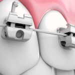 brackets-autoligados-lina-fernandez-odontologia