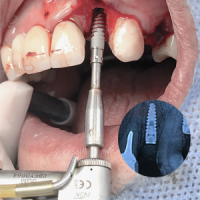 implantes-dentales-lina-fernandez-odontologia