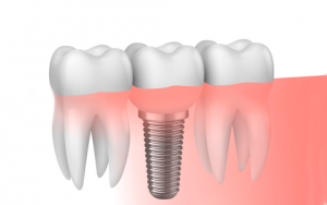 implantes-dentales-lina-fernandez-odontologia-servicio-consultorio-odontologico-medellin