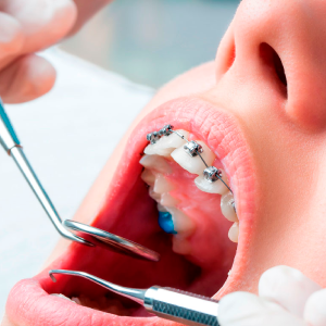 ortodoncia-tecnica-combinada-lina-fernandez-odontologia