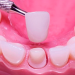 rehabilitacion-oral-corona-libre de metal-lina-fernandez-odontologia