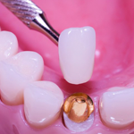 rehabilitacion-oral-coronametal-ceramica-lina-fernandez-odontologia