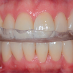 rehabilitacion-oral-placas-de-bruxismo-lina-fernandez-odontologia