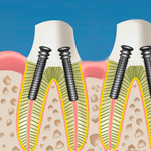endodoncia-multirradicular-lina-fernandez-odontologia